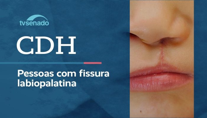 CDH Debate Atenção Integral para Fissura Labiopalatina